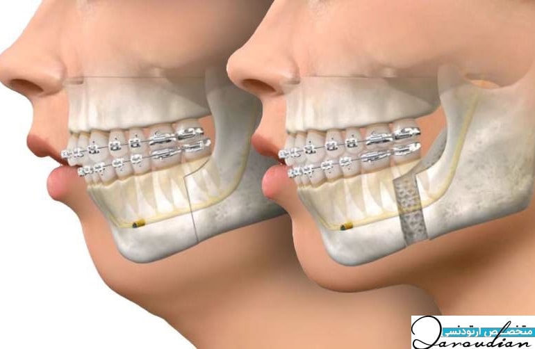 عوارض جراحی فک بدون ارتودنسی