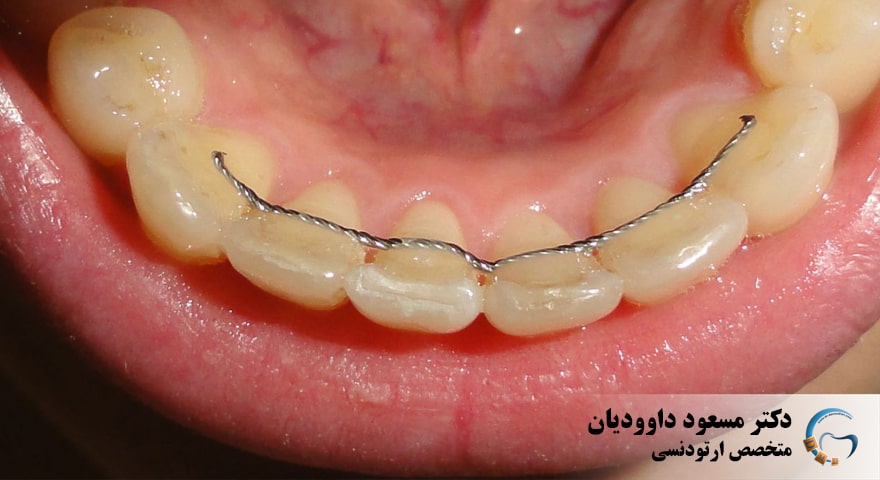 ارتودنسی-عود ارتودنسی