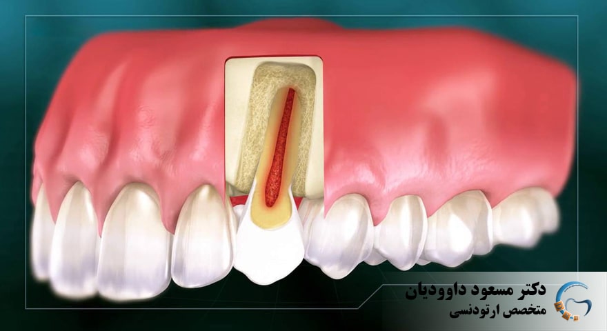 ارتودنسی-ارتودنسی دندان عصب کشی شده