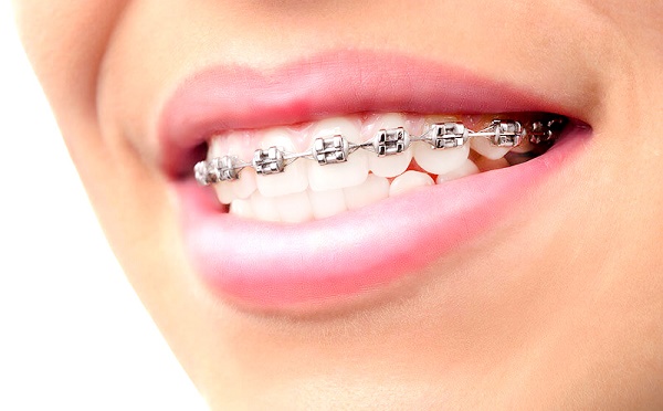 Prevention orthodontics3