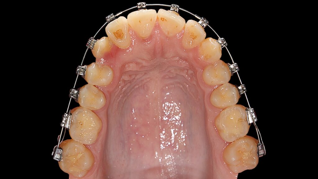 impacted canine orthodontics min2