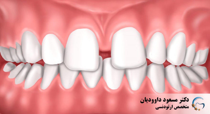 ارتودنسی-دندانهای فاصله دار