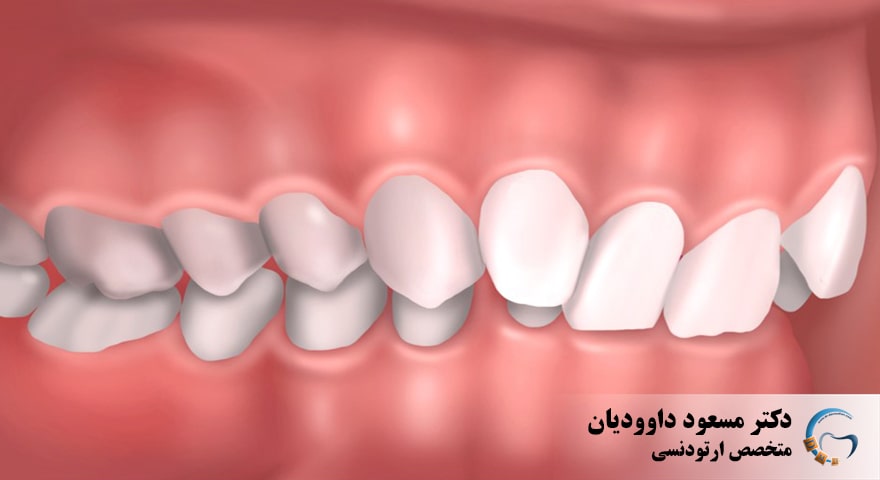 ارتودنسی-دیپ بایت