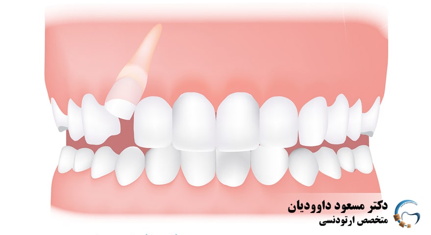 ارتودنسی-عقب بودن فک پایین