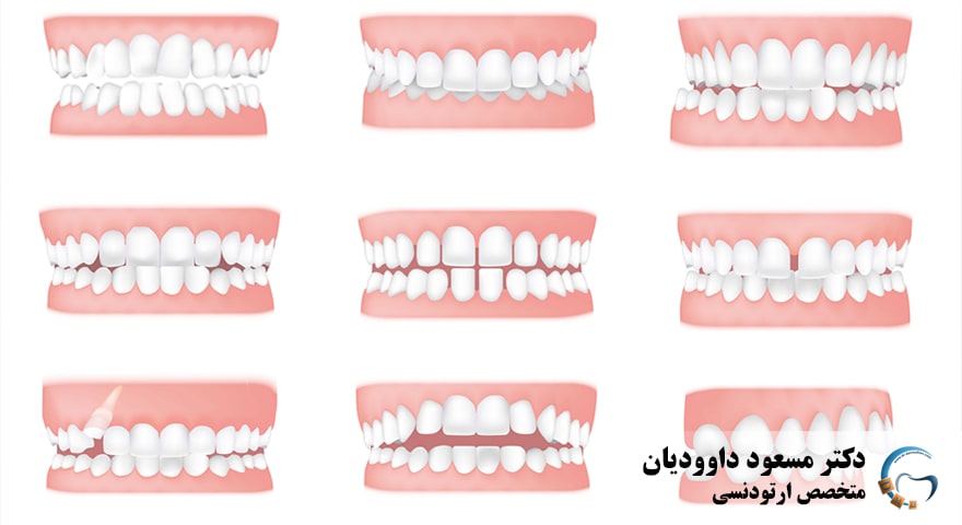 ارتودنسی-نامرتبی دندان