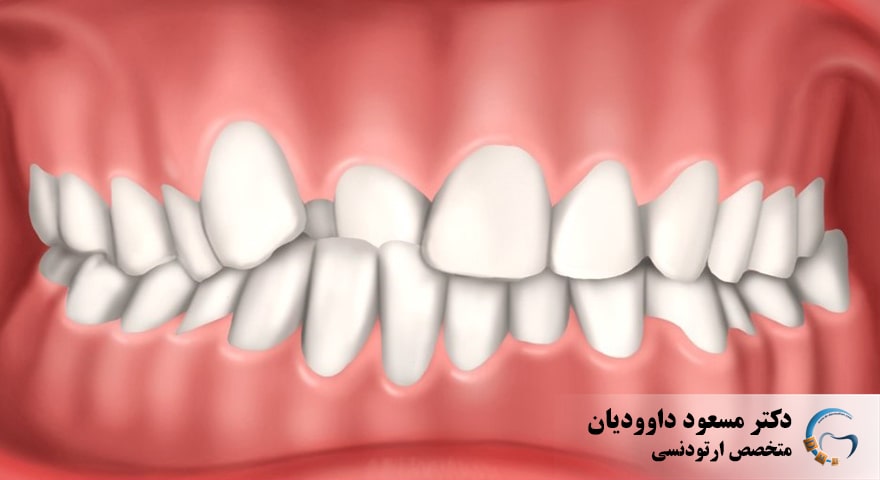 ارتودنسی-کراس بایت