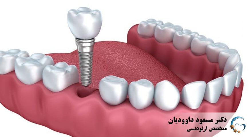 مراحل ایمپلنت دندان