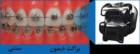 ارتودنسی-هزینه ارتودنسی دیمون