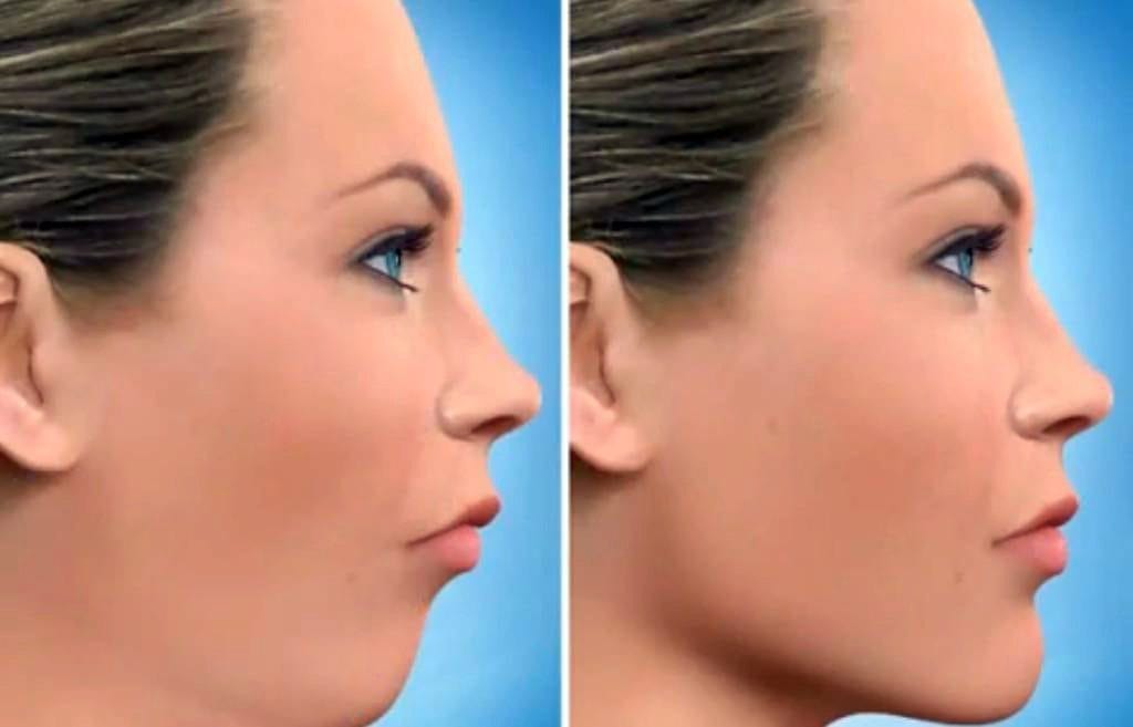 [تصویر:  jaw-surgery-chin-advancement-1024x657-1024x657-min.jpg]