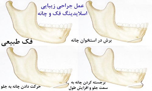 ارتودنسی-جراحی ژنیوپلاستی یا جراحی فک و چانه