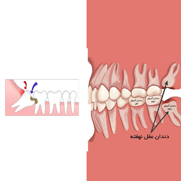 بهترین زمان مناسب کشیدن دندان عقل