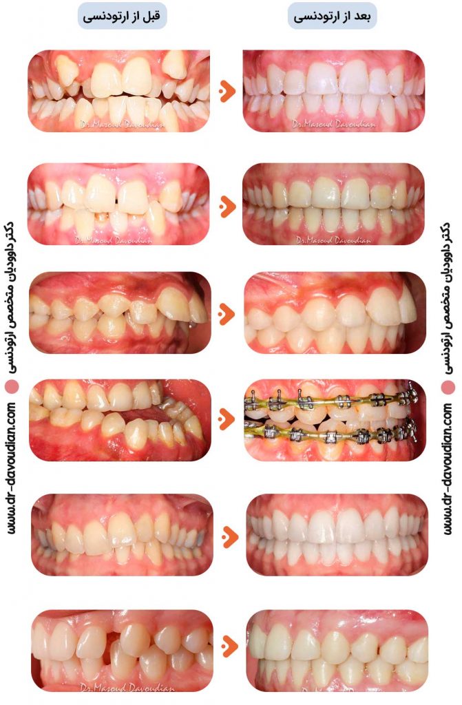 تصاویر قبل و بعد از ارتودنسی مربوط به بیماران دکتر داوودیان