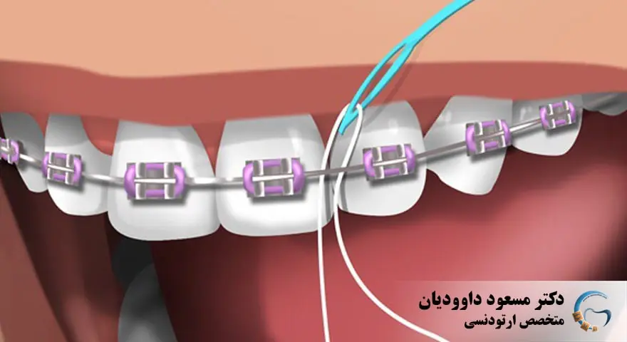 ارتودنسی-نخ دندان ارتودنسی