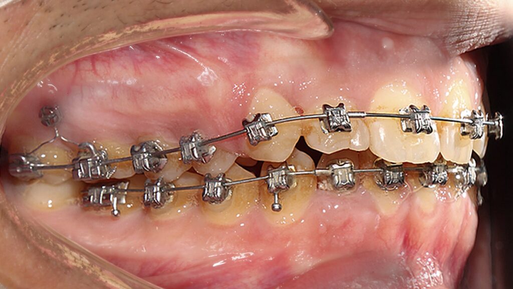 impacted canine orthodontics min5