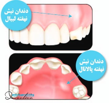 انواع نیش نهفته لبیال و پالاتال