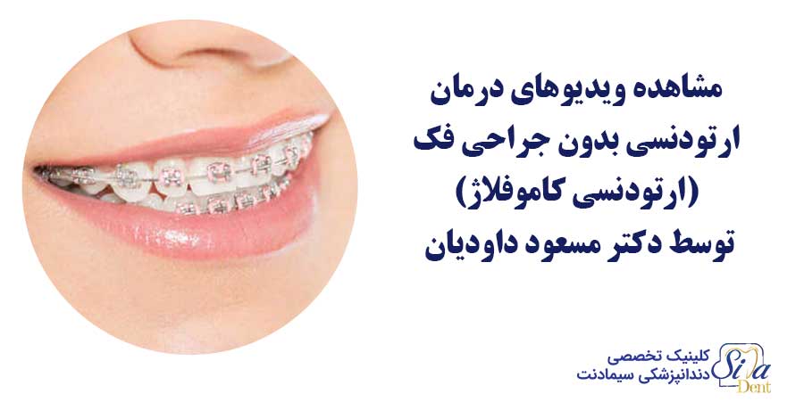 عکس و فیلم ارتودنسی بدون جراحی فک (ارتودنسی کاموفلاژ)