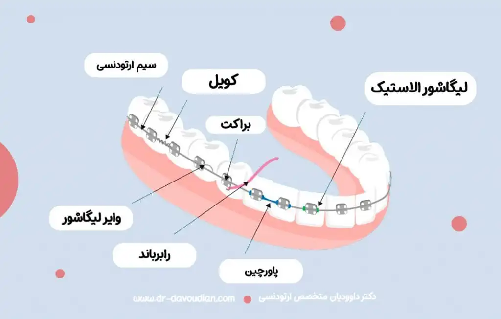 اجزای ارتودنسی سرامیکی کویل براکت سیم لیگاشور