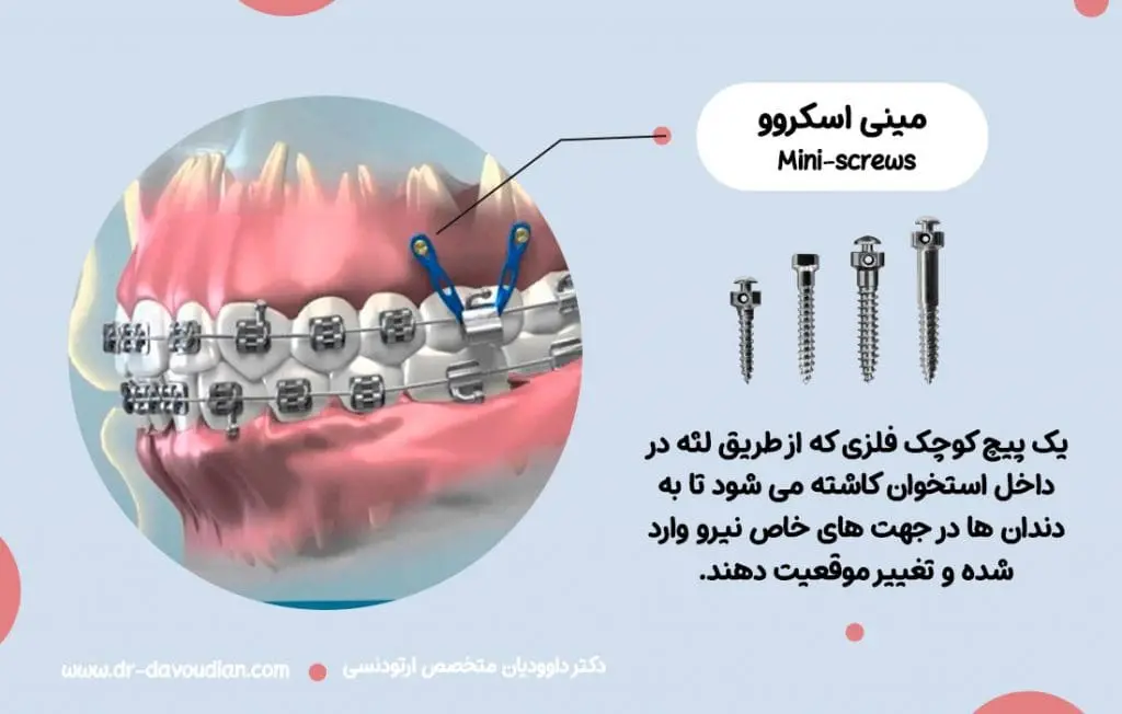 هزینه مینی‌اسکرو یا پیچ کوچک فلزی