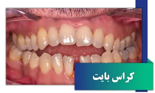 drdavoudian orthodontist crossbite1