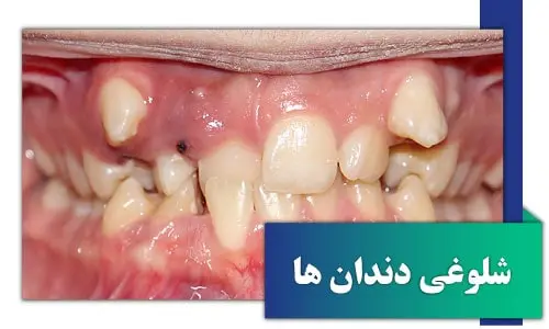 drdavoudian orthodontist crowded teeth1