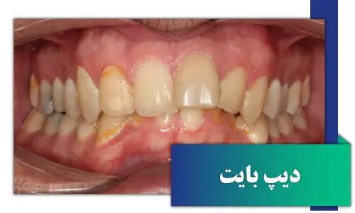 ناهنجاری دیپ بایت و مراجعه به متخصص ارتودنسی