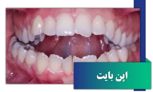 drdavoudian orthodontist openbite1