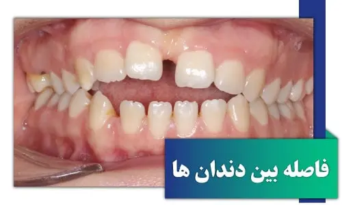 drdavoudian orthodontist spacing1