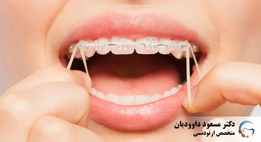 کش ارتودنسی و انواع آن