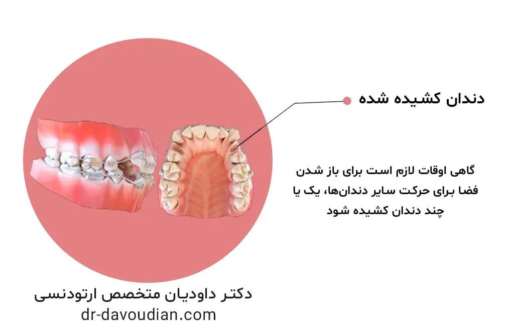 هزینه ارتودنسی ثابت با کشیدن دندان