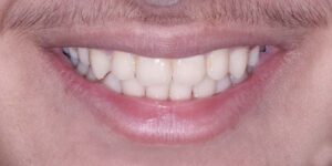 اصلاح عقب بودن فک پایین با ارتودنسی