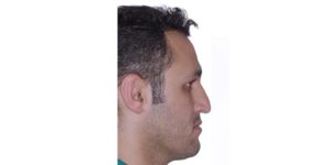 قبل از ارتودنسی دندان