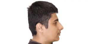 رفع عقب بودن فک پایین با ارتوودنسی