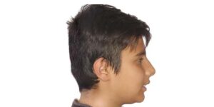 عقب بودن فک پایین