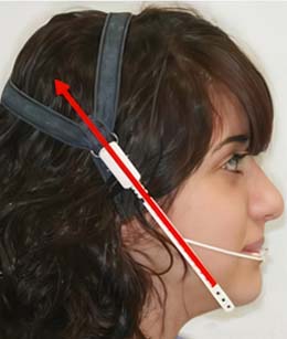 هدگیر ارتودنسی پس‌سری (Occipital Pull Headgear)