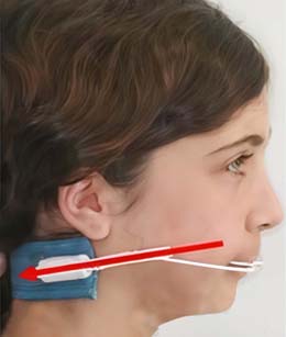 هدگیر ارتودنسی گردنی (Cervical Pull Headgear)