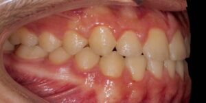 ارتودنسی جلو بودن فک پایین
