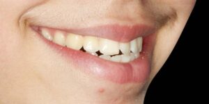 قبل از ارتودنسی دندان 4