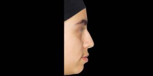 قبل از ارتودنسی دندان 6