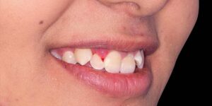 رفع بیرون زدگی دندان‌های نیش